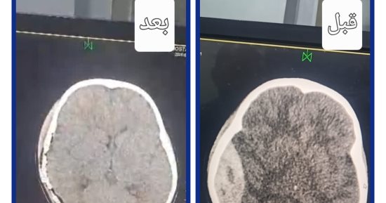 تدخل جراحي دقيق مرتين خلال 24 ساعة ينجح فى إنقاذ حياة طفل بمستشفى أجا المركزى