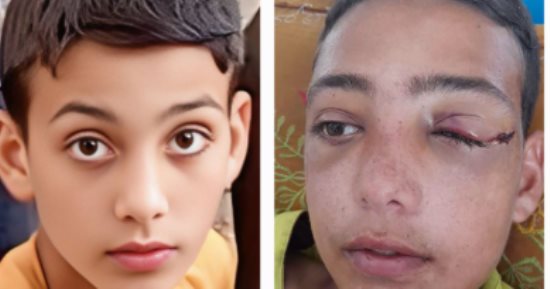 طفل غزة عبد الرحمن أبو جزر يفقد عينه وينتظر إجلاء عاجلا للعلاج خارج القطاع