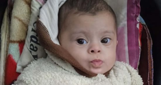 الرضيعة أمينة قشطة تصارع الموت في غزة بين متلازمة داون وعيب قلبي خطير