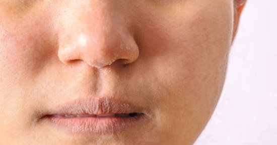 6 حيل سهلة وسريعة لترطيب البشرة والتخلص من الجفاف والجلد الميت