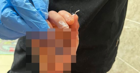 جراحة دقيقة تعيد الأمل.. إنقاذ فتاة من بتر كامل لليد بعد اعتداء بساطور بسوهاج
