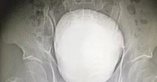 جراحة نادرة تنهى معاناة مزارع صينى مع حصوة ضخمة فى المثانة
