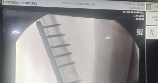 نجاح جراحة دقيقة لتثبيت كسر بالفخذ لطفل بمستشفى الفشن ببنى سويف