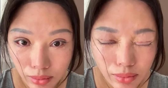 صينية تعجز عن إغلاق عينيها بعد جراحة تجميل فاشلة وتلزم بدفع تعويض للطبيب
