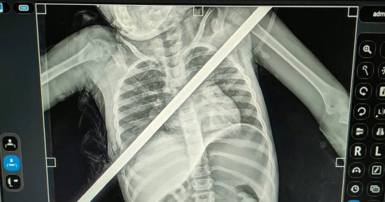 3 ساعات فى العمليات.. إنقاذ حياة طفلة اخترق سيخ حديد صدرها فى بنها الجامعى