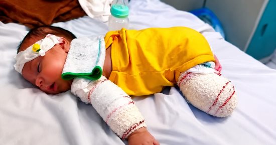 الرضيع محمد الخطيب فقد أمه وبترت قدمه فى الحرب وينتظر فرصة العلاج خارج غزة