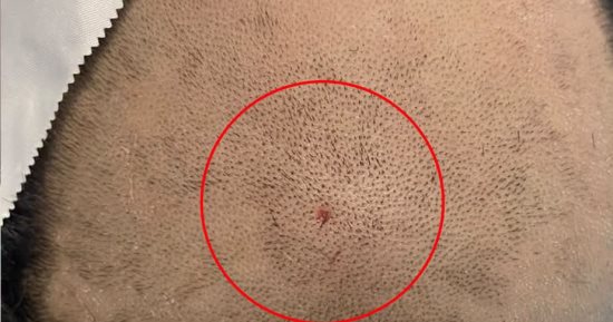 نجاح جراحة دقيقة لاستخراج مسمار ضغط هوائي من مخ طفل بالمنصورة