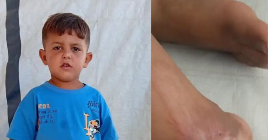 بيحلم يمشي تانى.. يزن علوان يخوض معركة مع الألم فى انتظار العلاج خارج غزة