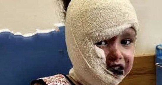الحروق سرقت طفولتها.. ريتال حلاوة تواجه الألم داخل خيمة لا تقيها حر الصيف في غزة.. ارتفاع درجات الحرارة يحول المعاناة إلى عذاب يومي يضاعف جراح طفلة لم تتجاوز السادسة.. وتحمل حلما مؤجلا لطفولة تستحق الحياة