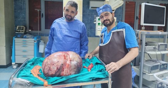 نجاح استئصال ورم مبيضي نادر يزن 24 كيلوجراما بمستشفى المنيا الجامعي