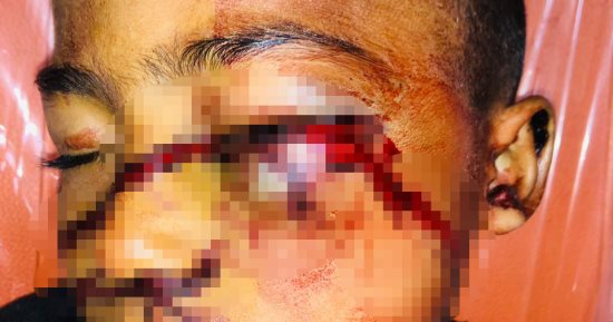استخراج رصاصة طائشة من مخ طفل بمستشفيات سوهاج الجامعية.. صور