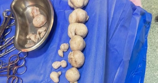  استئصال 21 ورم ليفي والحفاظ على رحم سيدة بمستشفى دسوق العام