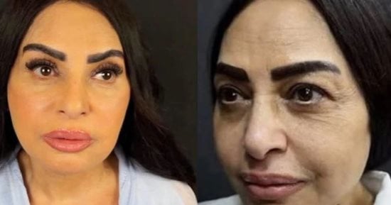 سلوى خطاب بعد عملية شد الوجه: كان عندى تكتلات دهنية فى وشى وشلتها