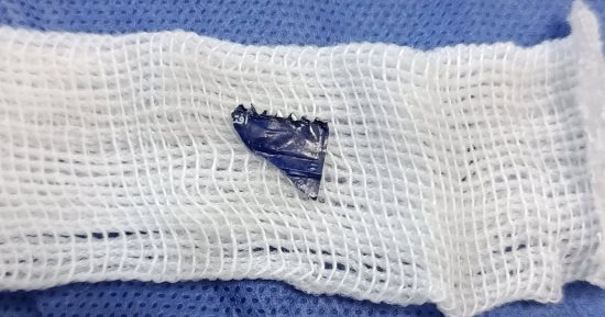 استخراج جزء من غلاف كيس مايونيز كاد يتسبب فى اختناق طفل 8 أشهر ببنها