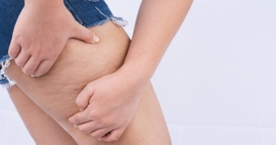 السيلوليت مع التقدم فى العمر.. لماذا يظهر وكيف يمكن تحسين مظهره؟