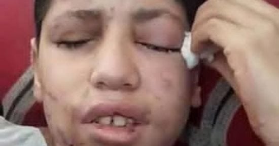 صرخة أم في العتمة.. إبراهيم أبو شاب فقد بصره وبُترت أصابع يده وأصيب بحروق وشظايا مزقت جسده في انفجار خلال الحرب على غزة.. 6 أشهر من الانتظار لتحويلته الطبية والأمل الأخير لعودة النظر من جديد
