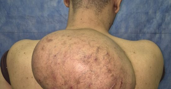 استئصال ورم دهني ضخم يزن 15 كجم من ظهر مريض بمستشفيات سوهاج الجامعية