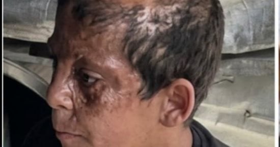يحيى عوض طفل من غزة نجا من الموت والحرب تركت حروقا عميقة في رأسه وغيرت ملامحه إلى الأبد.. الطفل الفلسطينى يقف أمام المرآة بحثا عن صورته القديمة.. ويحلم بعلاج وزراعة شعر تعيدان إليه شيئا من طفولته وثقته بنفسه