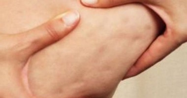 5 نصائح للقضاء على السيلوليت أهمها ممارسة الرياضة