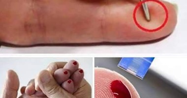 أستاذ مخ وأعصاب: وخز الأصابع لا يعالج جلطة المخ..تعرف على علامات الإصابة