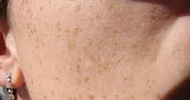 انتبهى.. أضرار لا تعرفينها عن كريمات إزالة الشعر.. حرق البشرة أبرزها