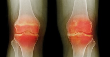 6 خطوات لعلاج التهاب المفاصل عند السيدات.. تعرفى عليها