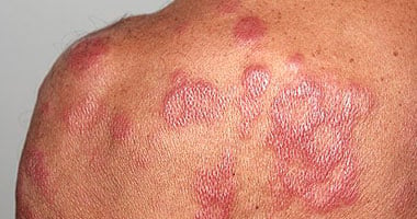 لو عندك جذام.. معلومات هامة لازم تعرفها عن تفاعل خطير قد يصيبك