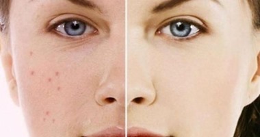 بعيدًا عن مستحضرات التجميل.. طريقة طبيعية للتخلص من آثار حب الشباب