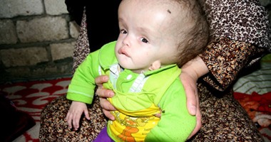 الرئيس يستجيب لحالة الطفلة "فاطمة" ويقررعلاجها بعد نشر اليوم السابع قصتها