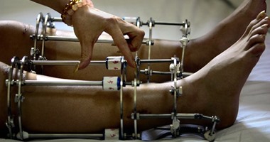 الجارديان: ازدهار عمليات تطويل الأرجل فى الهند