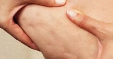 للنساء.. انتبهى أخطاء تزيد فرص إصابتك بالسيلوليت
