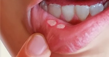 علاج قرحة الفم اهمها الشطف بمياه مالحة