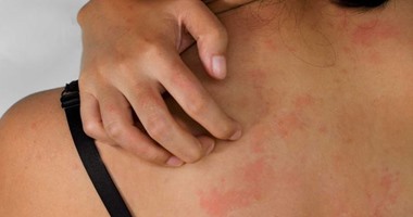 تعرف على أخطر أسباب الإصابة بالطفح الجلدى ..اضطرابات المناعه الذاتية أبرزها 