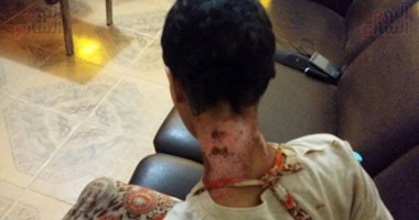 رئيس جامعة سوهاج يكلف أستاذ جراحة تجميل بتولى حالة "حياة" ضحية التعذيب 