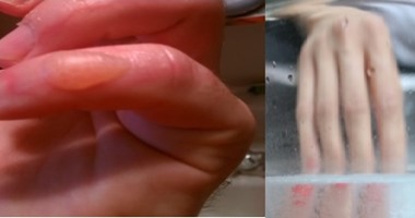 لحروق الجلد البسيطة.. 4 حلول منزلية تقضى عليها
