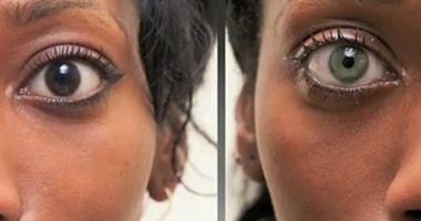 بالصور.. أغرب جراحات التجميل.. تغيير لون القزحية يحيل العدسات اللاصقة للمعاش.. والبوتكس الطريق للوجه الغامض.. وطابع الحسن وسيلة إغرائية بسيطة.. وتغيير خطوط الكف وأذن الكائنات الفضائية أحدث الصيحات