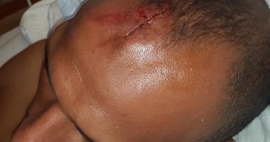 "4"غرز فى رأس إينو بسبب حمام السباحة