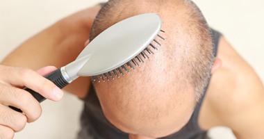 أخصائية أمراض جلدية توضح أسباب وطرق علاج صلع الرجال