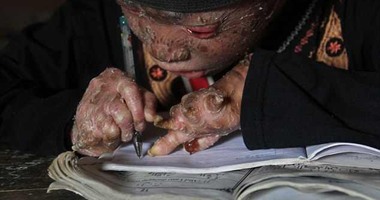 بالصور.."الفتى الثعبان" طفل إندونيسى تتقشر بشرته وتتساقط كجلد الثعبان