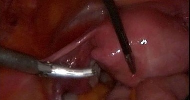 فريق من جامعة المنصورة يستأصل ورم ليفى من رحم سيدة 40سنه بالمنظار