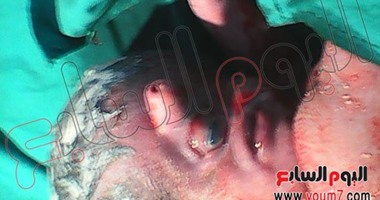 بالصور.. أغرب خمسة حالات ولادة بمصر.. ولادة طفل بعين واحدة ببنى سويف.. وآخر يشبه المخلوقات الفضائية بالقاهرة.. وأم تضع طفلا بجسد واحد ورأسين بأسيوط.. و"أحمد ومحمد إبراهيم" أشهر توأم ملتصق فى مصر
