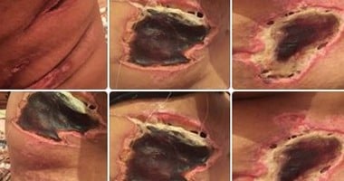 صحافة المواطن.. قارئ يستغيث لمعالجة شقيقته بعد عملية تجميل خاطئة