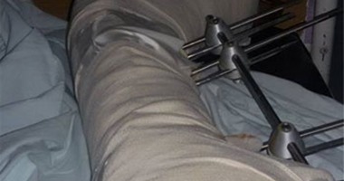 وداعا للشرائح والمسامير..حقنة من نشا الذرة والطين البركانى أحدث علاج للكسور