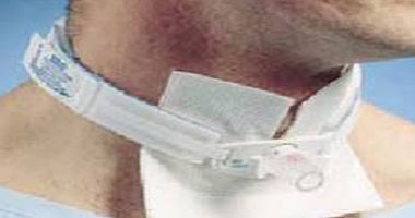 نجاح أول عملية زراعة أنبوب للتنفس لطفلة عمرها عامين