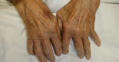 استشارى روماتيزم يستعرض روشتة لمقاومة أعراض مرض الروماتويد