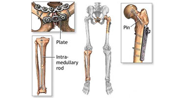 ما الأورام اللحمية للعظام Osteosarcomas