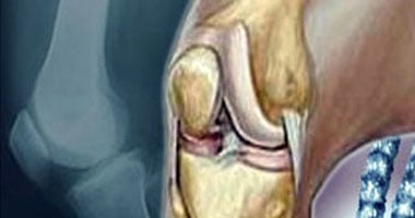 دراسة تشير بأصابع الاتهام إلى دور الغضاريف فى التهاب المفاصل