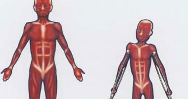 أستاذ مخ وأعصاب: ضمور العضلات يصيب طفلا من 3500 مولود ذكر