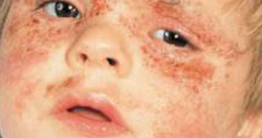 يعانى ابنى من تغير لون البقع فى جسمه أو الشامات فهل هذا جيد أم لا؟