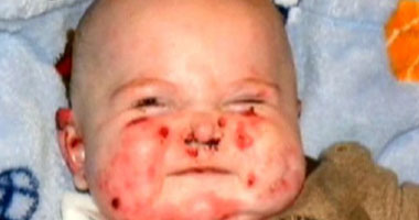 بالصور.. "الفراشة" مرض جلدى نادر يصيب طفلا ويجعل بشرته هشة